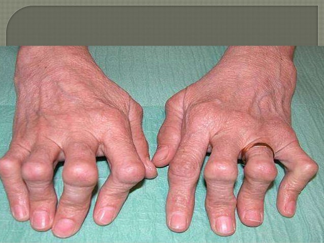 acute-rheumatic-fever-ppt-final-copy
