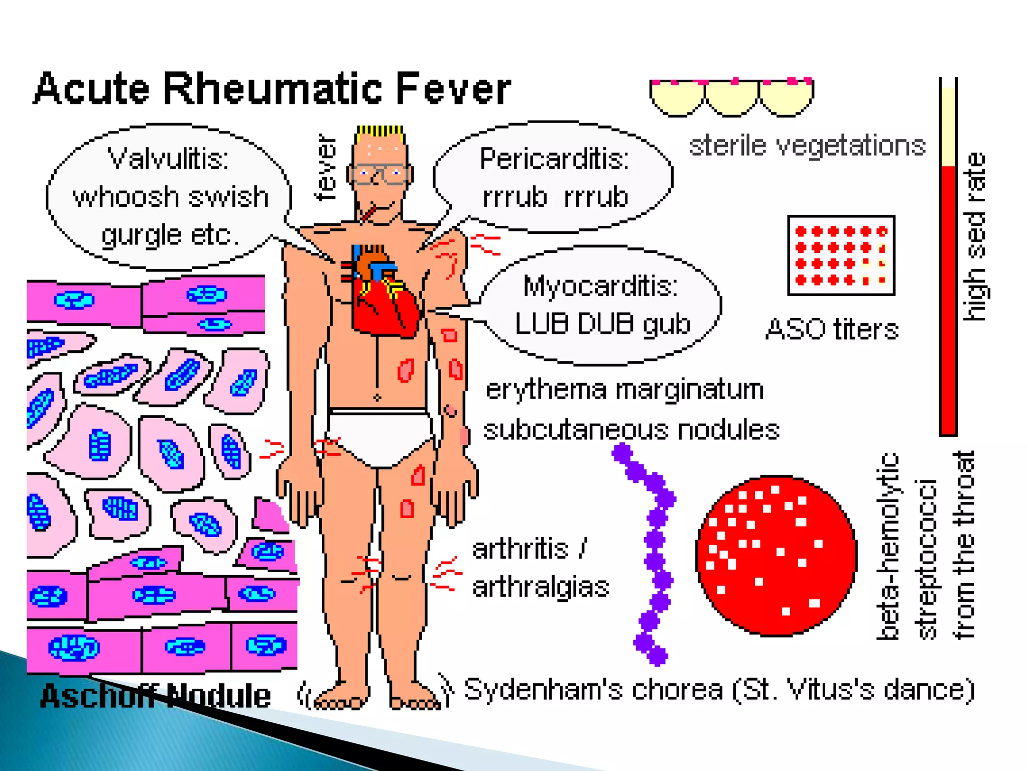 Acute Rheumatic Fever | PPTX