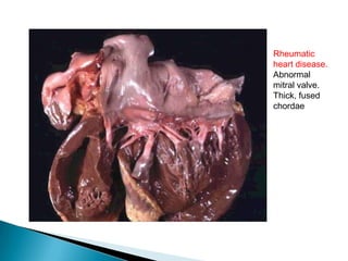 Another view of
thick and fused
mitral valves in
Rheumatic
heart disease

 