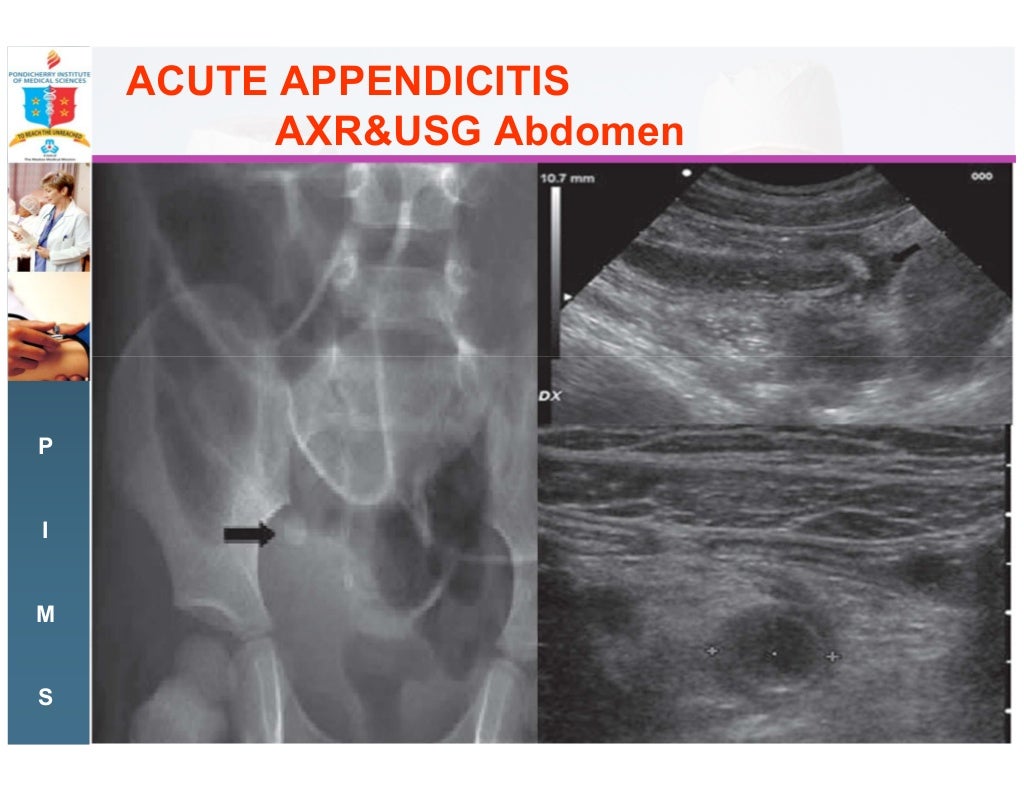 Acute right iliac fossa pain the commonest surgical emergency