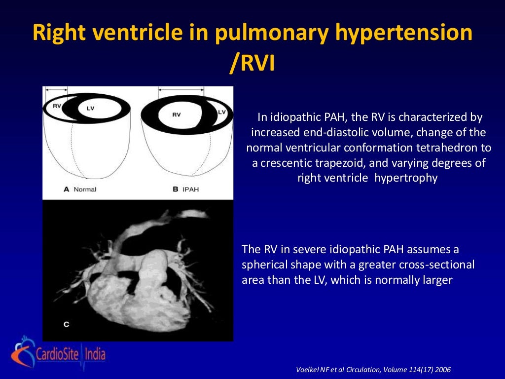 Acute rv failure physiology to management