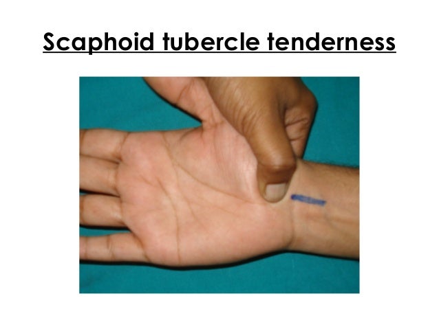 Acute scaphoid fractures