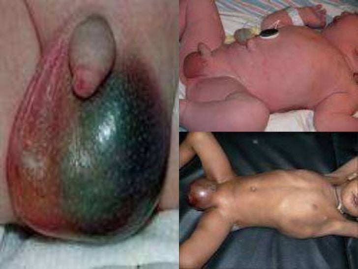Dildos and anal sex toys Swelling between anus and scrotum