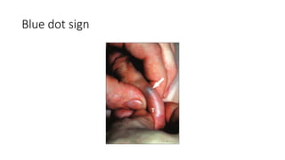 acute scrotum, a discussion by urologist | PPTX