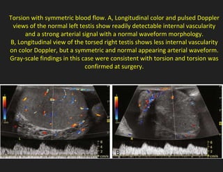 Torsion with symmetric blood flow. A, Longitudinal color and pulsed Doppler
views of the normal left testis show readily detectable internal vascularity
and a strong arterial signal with a normal waveform morphology.
B, Longitudinal view of the torsed right testis shows less internal vascularity
on color Doppler, but a symmetric and normal appearing arterial waveform.
Gray-scale findings in this case were consistent with torsion and torsion was
confirmed at surgery.
 
