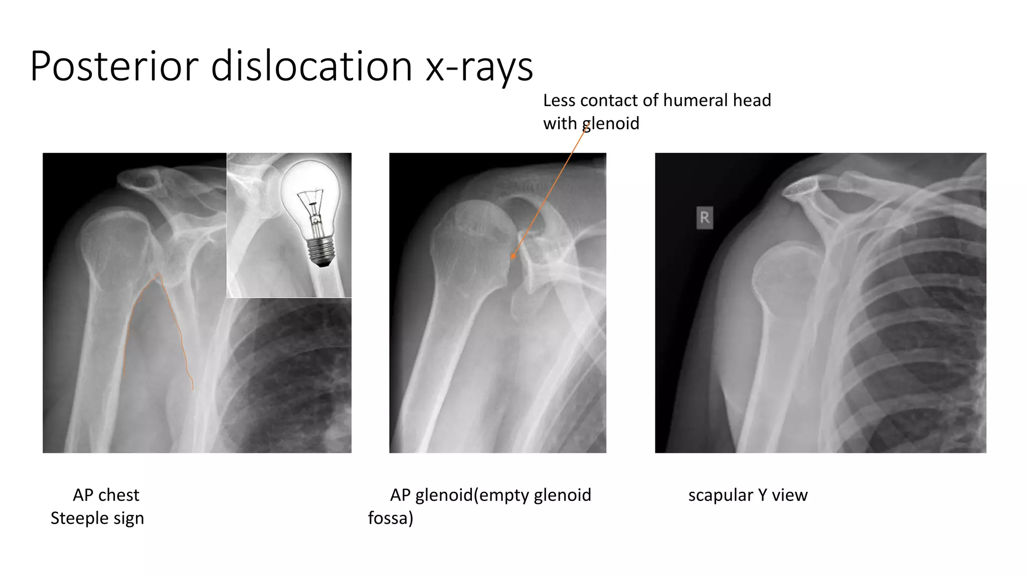 Posterior dislocation x-rays
AP chest
Steeple sign
AP glenoid(empty glenoid
fossa)
scapular Y view
Less contact of humeral head
with glenoid
 