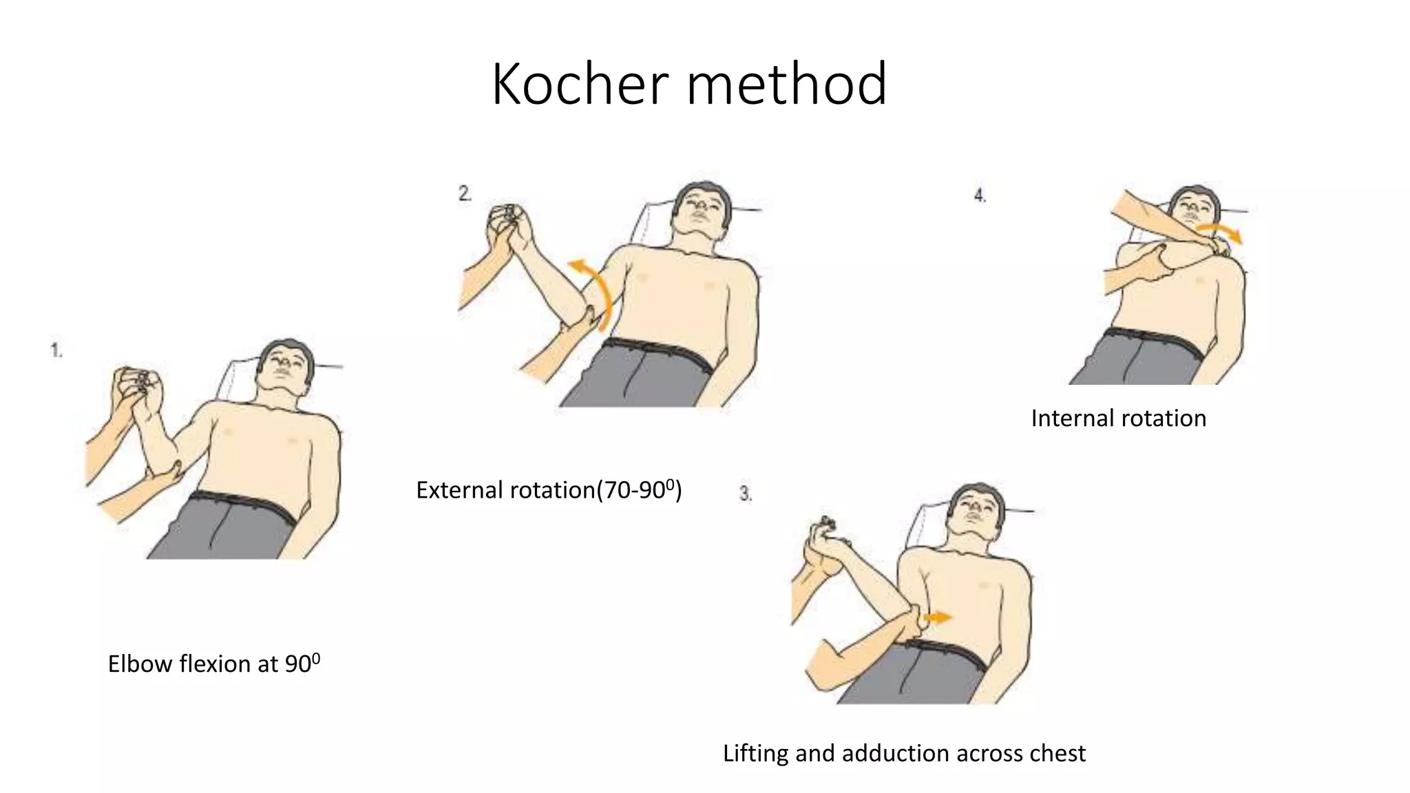 Kocher method
Elbow flexion at 900
External rotation(70-900)
Lifting and adduction across chest
Internal rotation
 