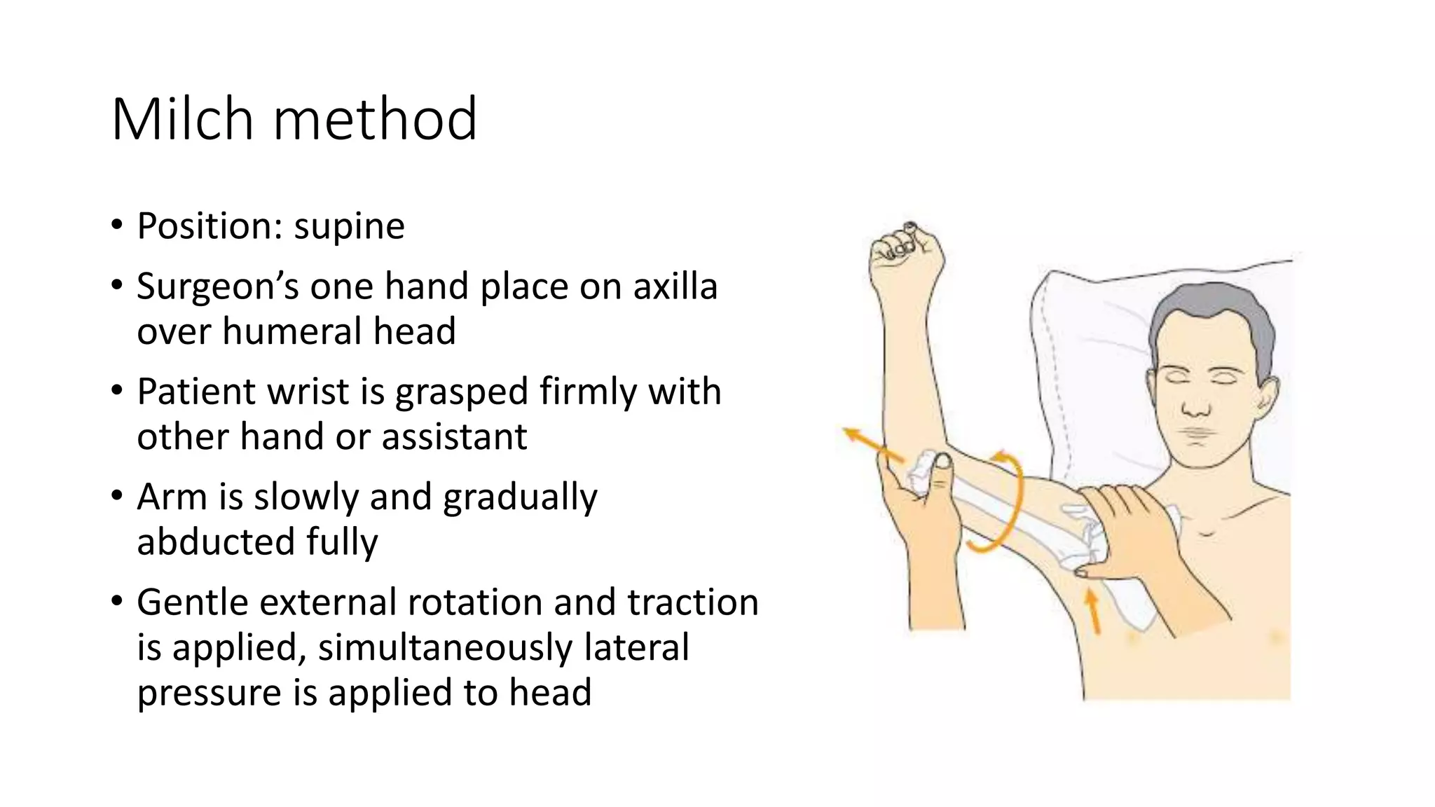 Milch method
• Position: supine
• Surgeon’s one hand place on axilla
over humeral head
• Patient wrist is grasped firmly with
other hand or assistant
• Arm is slowly and gradually
abducted fully
• Gentle external rotation and traction
is applied, simultaneously lateral
pressure is applied to head
 