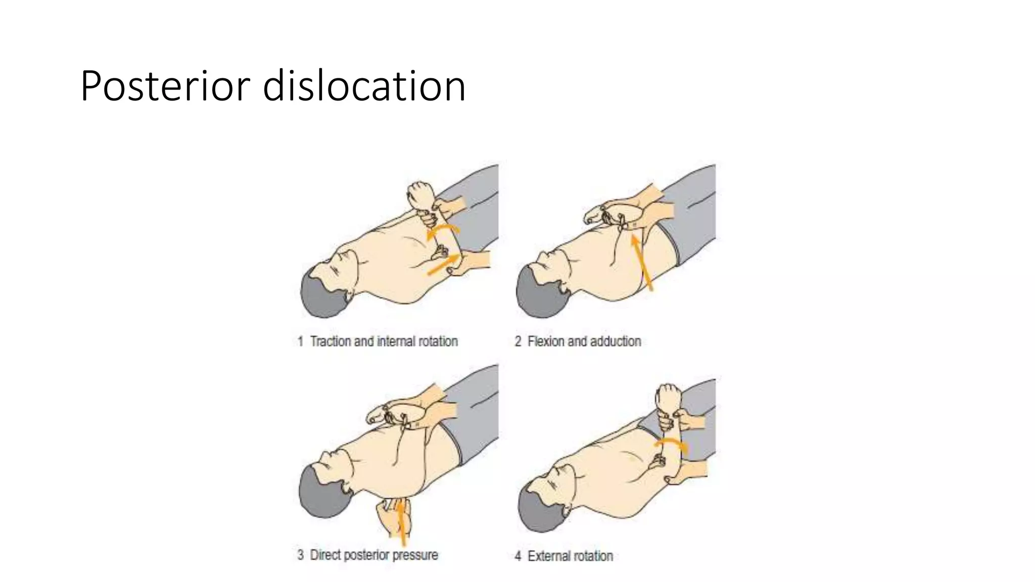 Posterior dislocation
 