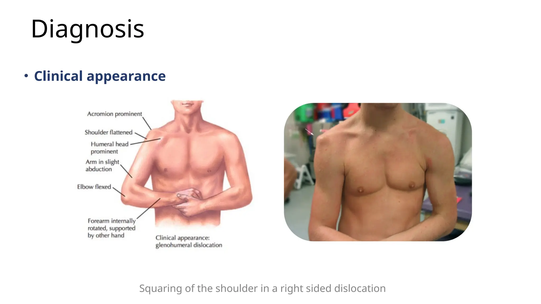 Acute Shoulder Dislocation (Traumatic Dislocation of the Glenohumeral Joint).pptx