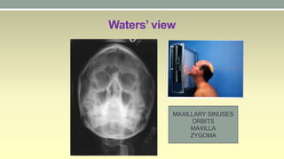 Walters View Acute sinusitis | PPTX