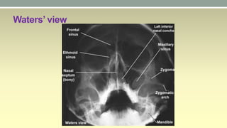 Walters View Acute sinusitis | PPTX