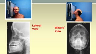 Walters View Acute sinusitis | PPTX