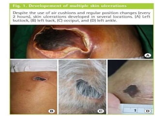 Skin Failure Acute skin failure | PPTX