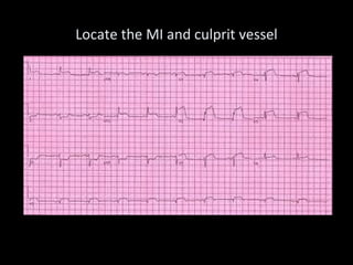 Locate the MI and culprit vessel 