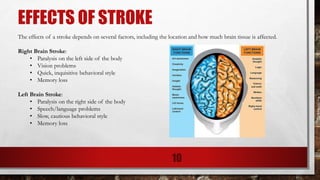 EFFECTS OF STROKE
The effects of a stroke depends on several factors, including the location and how much brain tissue is affected.
Right Brain Stroke:
• Paralysis on the left side of the body
• Vision problems
• Quick, inquisitive behavioral style
• Memory loss
Left Brain Stroke:
• Paralysis on the right side of the body
• Speech/language problems
• Slow, cautious behavioral style
• Memory loss
10
 