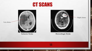 CT SCANS
Ischemic Stroke Hemorrhagic Stroke
Less dense
Highly dense
14
 
