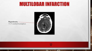 MULTILOBAR INFARCTION
Hypodensity
>1/3 cerebral hemisphere
17
 