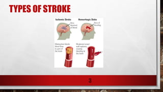 TYPES OF STROKE
3
 