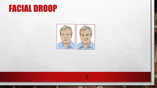 FACIAL DROOP
7
 