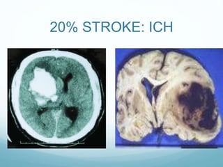 20% STROKE: ICH
 