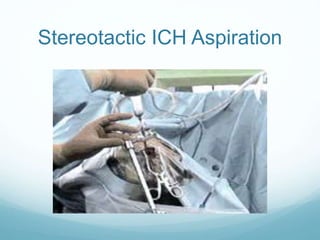 Stereotactic ICH Aspiration
 