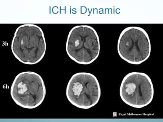 ICH is Dynamic
 