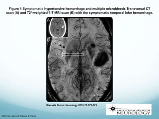 Figure 1 Symptomatic hypertensive hemorrhage and multiple microbleeds Transversal CT
scan (A) and T2*-weighted 7-T MRI scan (B) with the symptomatic temporal lobe hemorrhage.
Biessels G et al. Neurology 2010;75:572-573
©2010 by Lippincott Williams & Wilkins
 