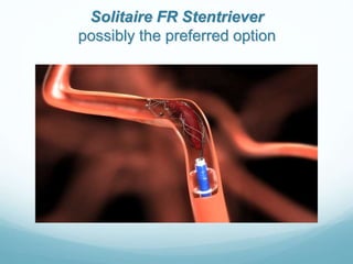 Solitaire FR Stentriever
possibly the preferred option
 