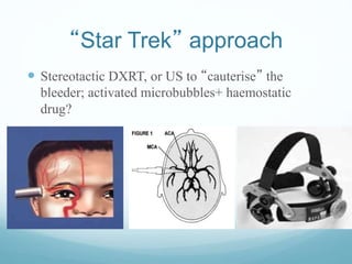 “Star Trek” approach
 Stereotactic DXRT, or US to “cauterise” the
bleeder; activated microbubbles+ haemostatic
drug?
 