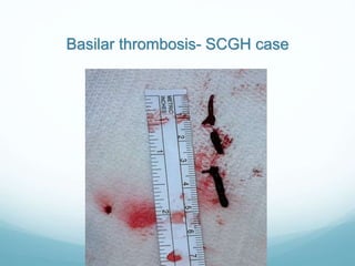 Basilar thrombosis- SCGH case
 