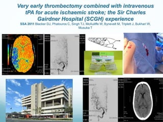 Very early thrombectomy combined with intravenous
tPA for acute ischaemic stroke; the Sir Charles
Gairdner Hospital (SCGH) experience
SSA 2011 Blacker DJ, Phatouros C, Singh TJ, McAuliffe W, Bynevelt M, Triplett J, Bukhari W,
Musuka T
 