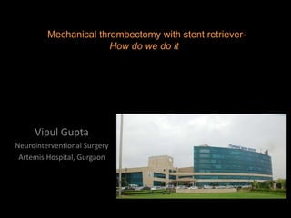 BALLOON ASSISTED COILING IN
RUPTURED CEREBRAL ANEURYSMS
Vipul Gupta
Neurointerventional Surgery
Artemis Hospital, Gurgaon
Mechanical thrombectomy with stent retriever-
How do we do it
 