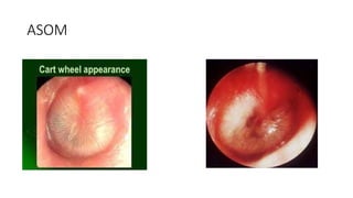 ACUTE SUPPURATIVE OTITIS MEDIA. Lecture slide | PPTX