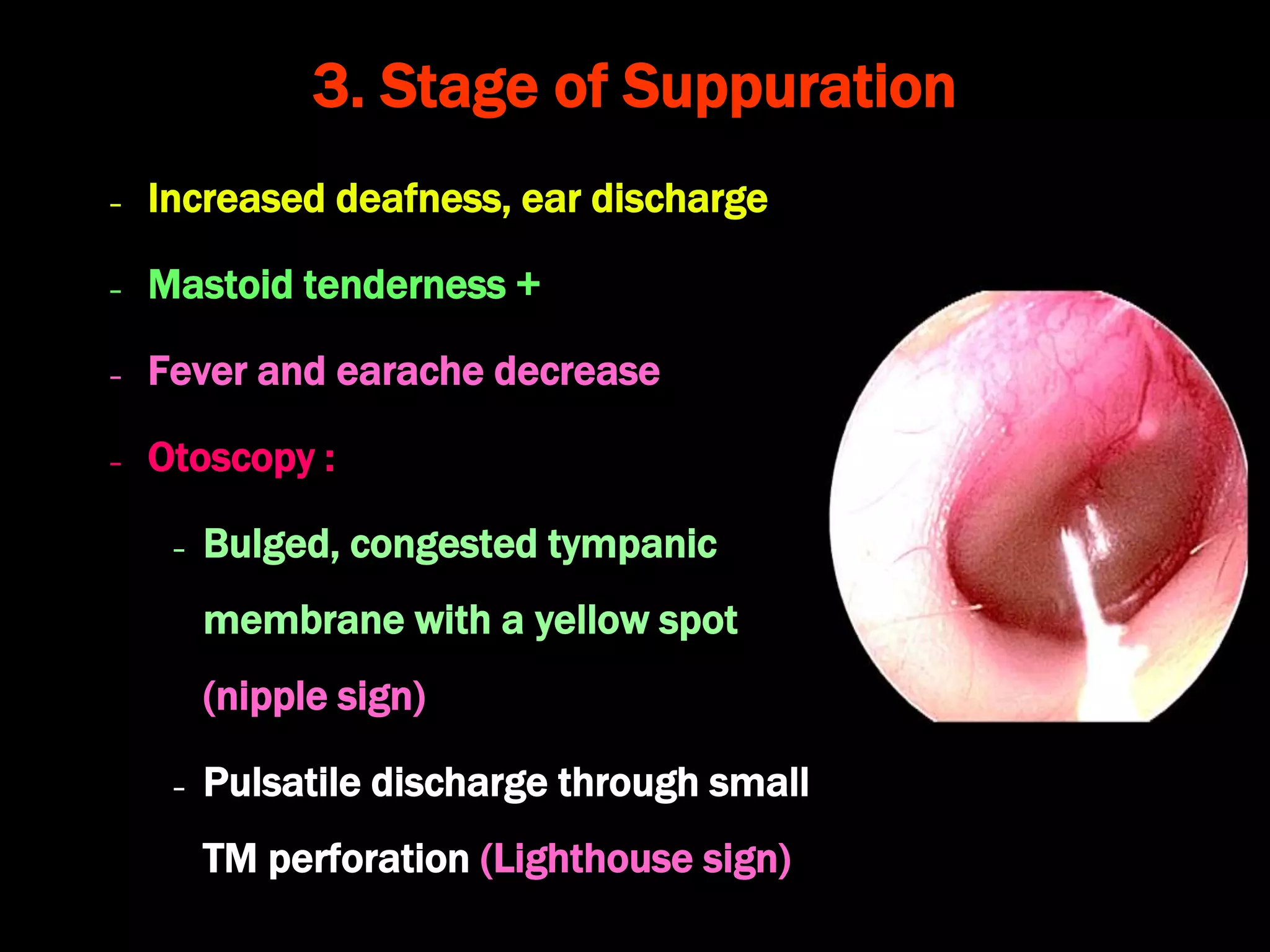 Acute suppurative otitis media and and cortical mastoidectomy | PPT
