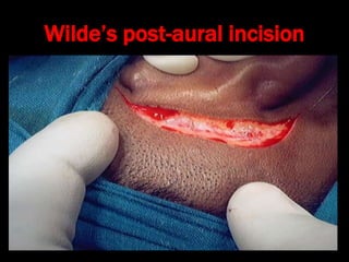 Acute suppurative otitis media and and cortical mastoidectomy | PPT