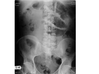 Acute Abdomen - Julie Cornish
