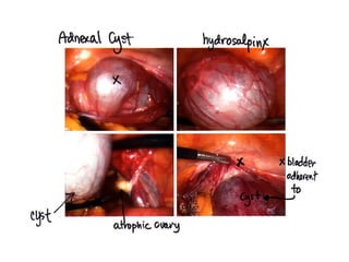 Acute Abdomen - Julie Cornish