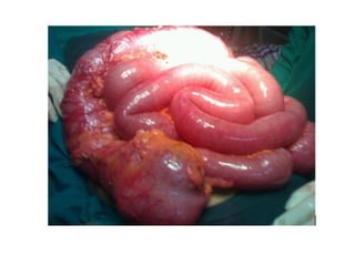 Acute Abdomen - Julie Cornish