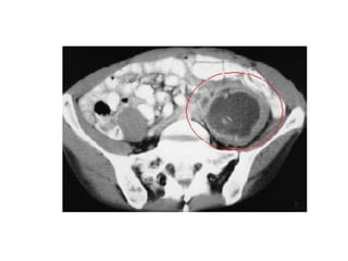 Acute Abdomen - Julie Cornish