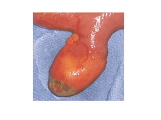 Acute Abdomen - Julie Cornish