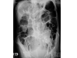 Acute Abdomen - Julie Cornish