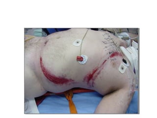 Acute Abdomen - Julie Cornish
