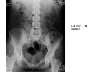 Self harm – FB
insertion
 