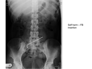 Self harm – FB
insertion
 