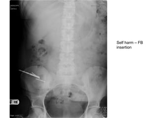 Self harm – FB
insertion
 