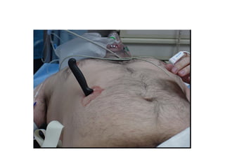 Acute Abdomen - Julie Cornish