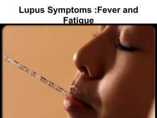 Lupus Symptoms :Fever and
         Fatigue

                            . •
 