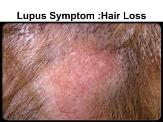 Lupus Symptom :Hair Loss


                       . •
 