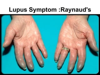 Lupus Symptom :Raynaud's
 
